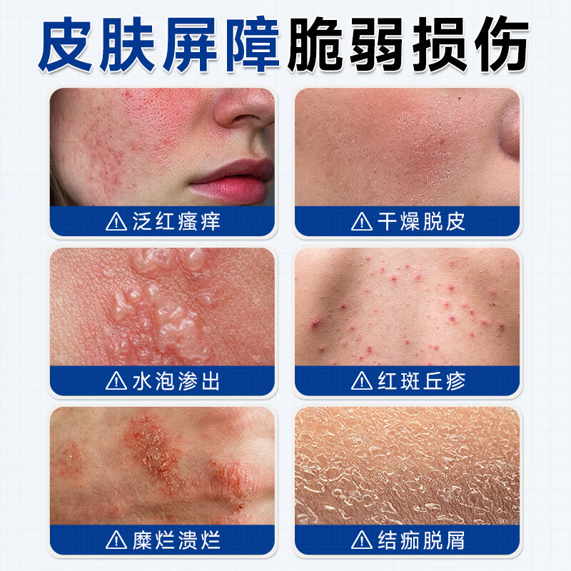 香港大药房湿疹膏搭湿疹药膏皮肤瘙痒皮炎湿疹真菌王感染止痒皮癣阴 单盒【轻度湿疹】体验装