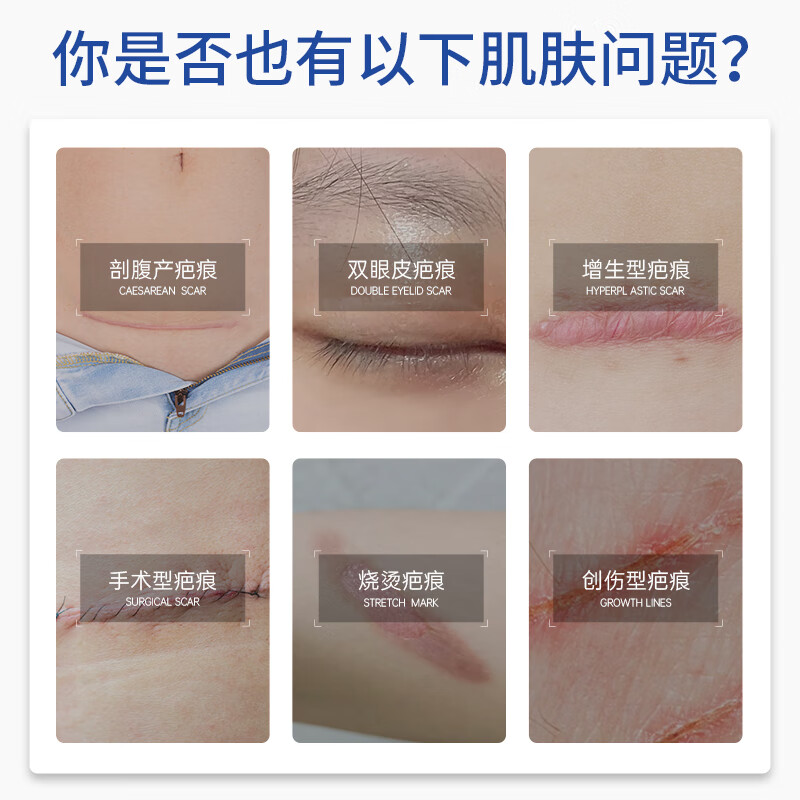 VEVT疤痕贴VVT硅酮贴EVT小蓝板剖腹产疤痕贴硅酮改善疤痕 一盒装（新生疤痕）