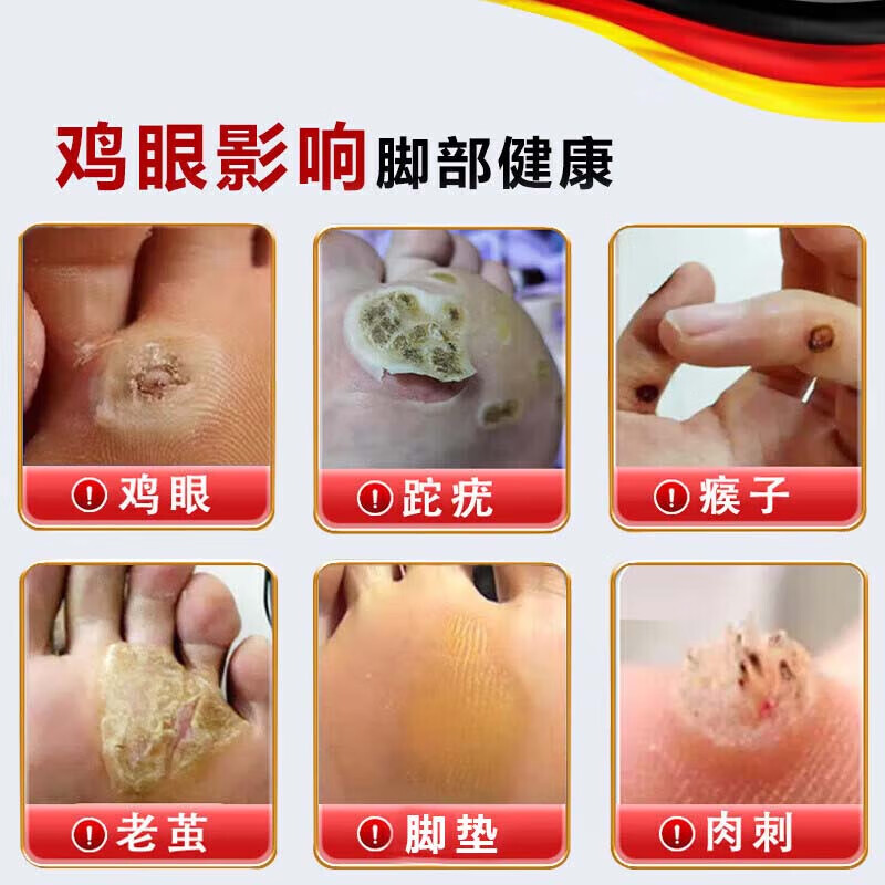 保中寳鸡眼膏贴去脚跟鸡眼膏贴去肉根刺刺猴无.痛脱落连根.拔鸡眼去除药 特效：1盒【鸡眼专用】