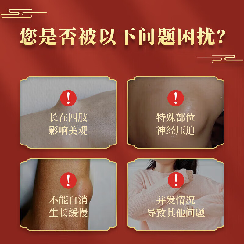 脂肪康贴脂康贴脂肪瘤贴专用皮下多发性脂肪瘤粒去除囊 5盒装[买三赠二]疗程装