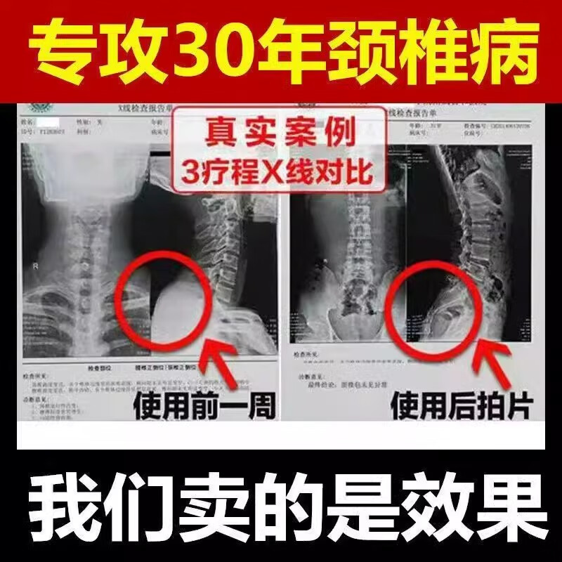 梦若羽（MRYU）霍教授颈椎贴膏肩周酸疼痛压迫神经脑供血不足药膏正品 5盒【买三送二 周期护理】 官方授权