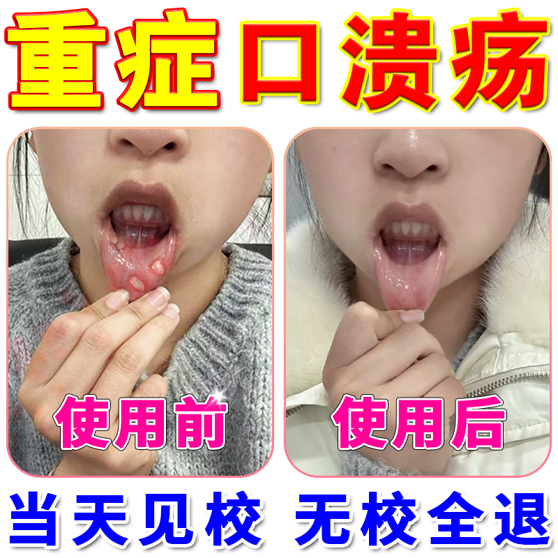 安其生口腔溃疡凝胶修复剂溃疡药口舌起泡生疮上火消肿抑菌贴喷片进口膏 1盒【热销装】可试用7天