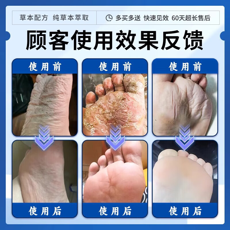 北京同仁堂脚汗脚臭专用出汗多除脚酸脚气止汗泡脚癣克星真菌感染喷雾剂正品 买5送4【重度装】止汗神器