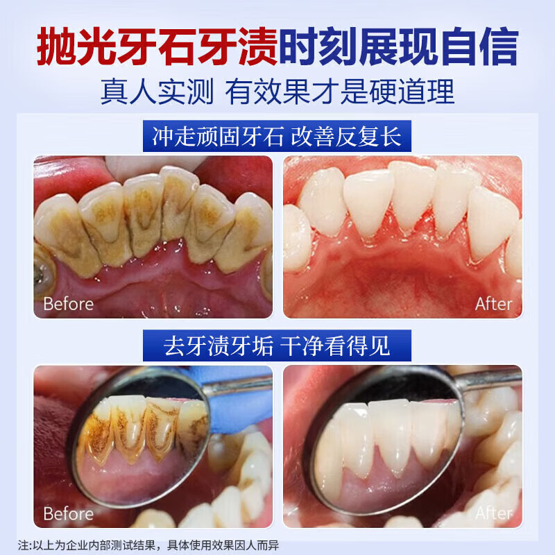 香港大药房去牙结石型口腔冲洗器喷雾牙齿膏去味口臭去黄溶解去渍牙石速效 5盒：（10年以上可掉）买3送2