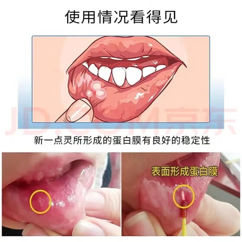 牙德安一点灵口腔溃疡液得安1.5ml口腔粘膜液腔溃疡官方旗舰 一盒[体验装]