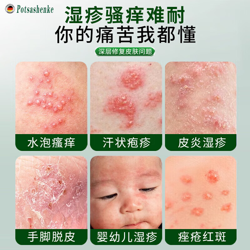 岩井昃弘湿疹膏十大牌子进口湿疹膏止痒抑菌皮肤瘙痒去顽固湿毒真菌感染 特效3盒【100%一抹见校】湿疹膏药十大牌子 湿疹十大牌子皮肤瘙痒皮炎湿疹