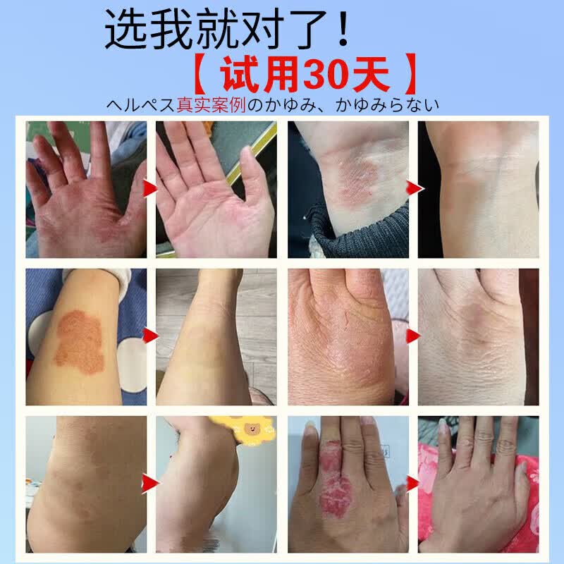 日本化藥【一抹止痒】日本特效炉甘石皮肤干痒抑菌润肤乳全身适用止痒药膏 1瓶体验装【3秒快速止痒】温和配方不过敏 湿i诊外用全身皮肤手脚干痒真菌杀菌