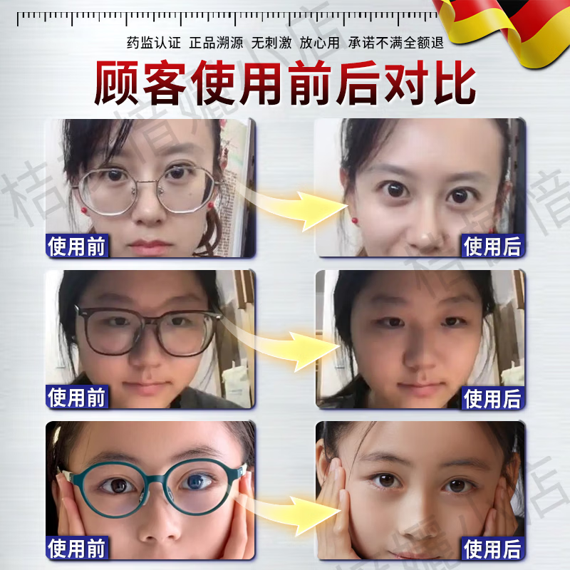 秋雅奈绪眼贴缓解眼疲劳改善视力青少年近视力i恢复治疗i近视儿童眼药水降 【医用近视眼贴】一盒 度数治疗矫正缓解眼疲劳改善视力