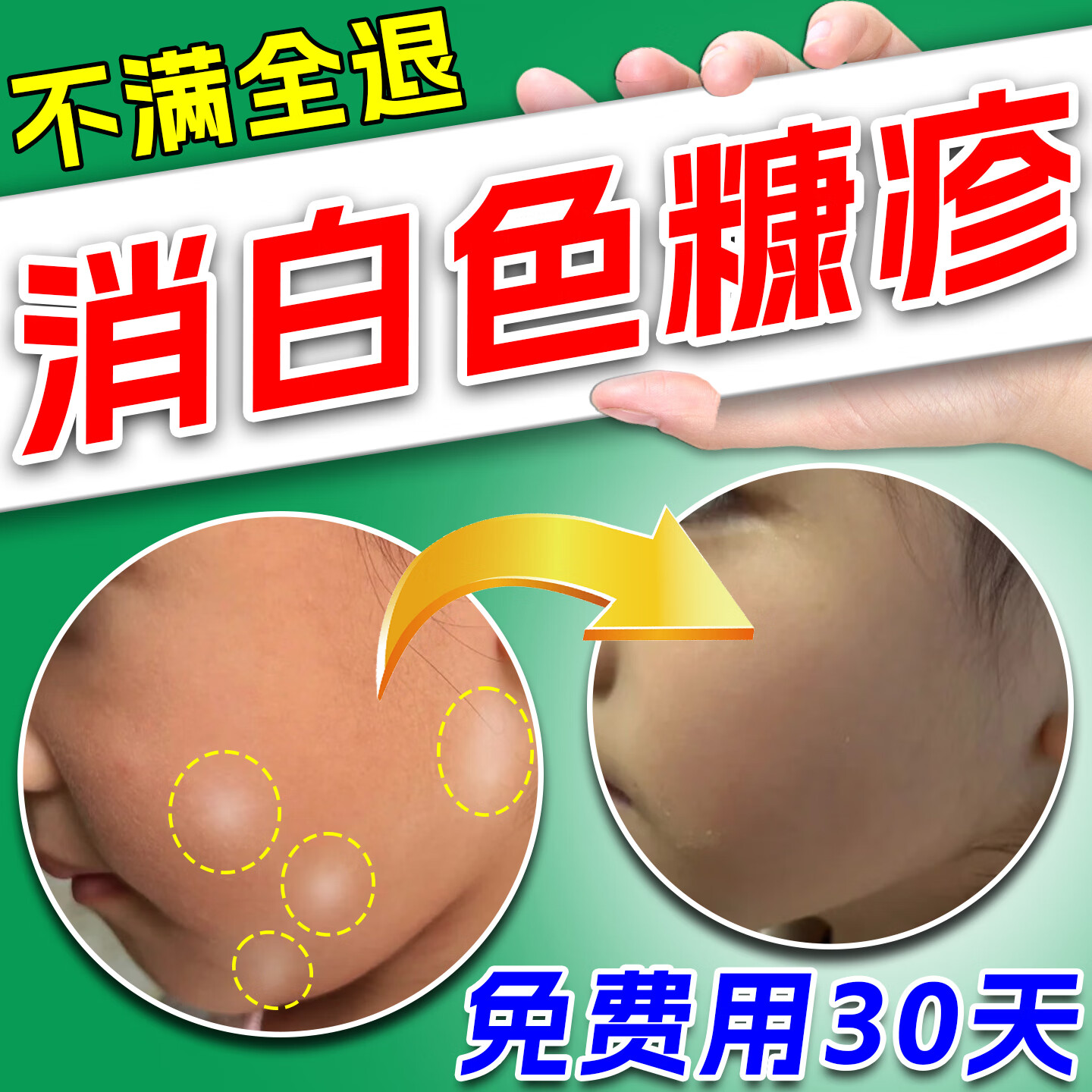 白色糠疹儿童用药宝宝脸部上长白斑汗斑癣皮肤病专用维