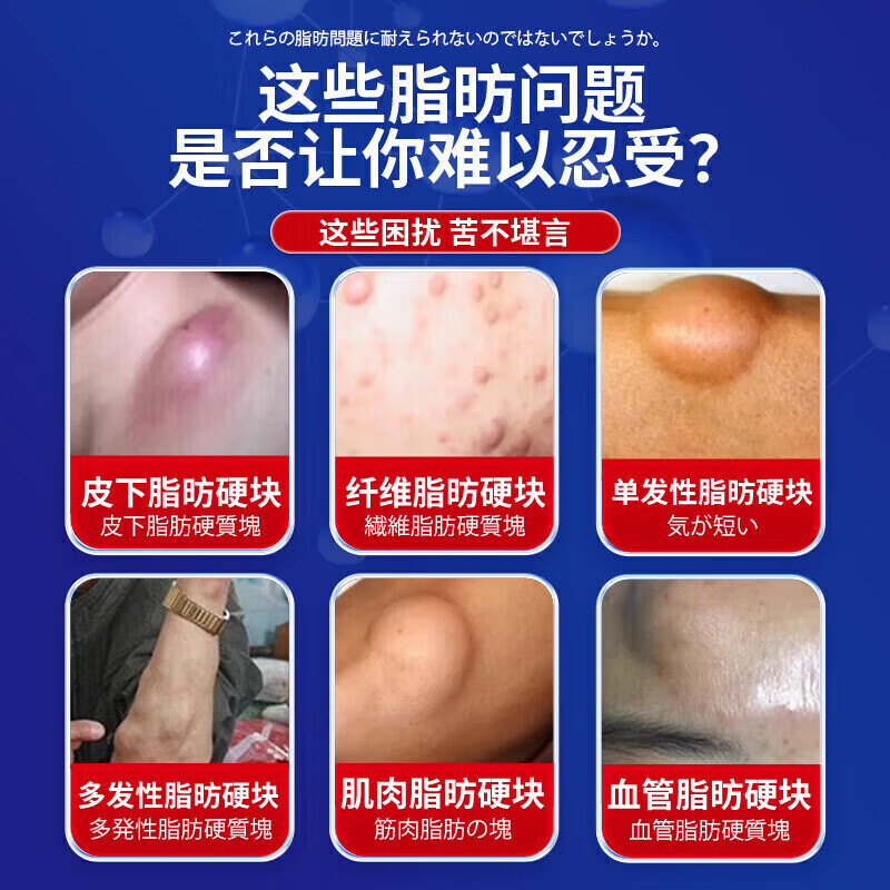 云南本草脂肪康脂肪瘤专用膏药去除神器消除硬块鼓包脂肪消散膏皮下囊肿 5盒膏【 脂肪瘤终结者】脂肪康 陈九玄脂肪瘤膏皮下多发性鼓包