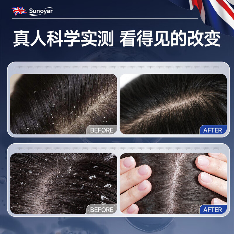 Sunoyar毛囊炎洗发水头皮痒止痒头部脂溢性专用马拉色菌抗真菌 10瓶装【买5送5超豪华】毛囊炎不反复抗真菌