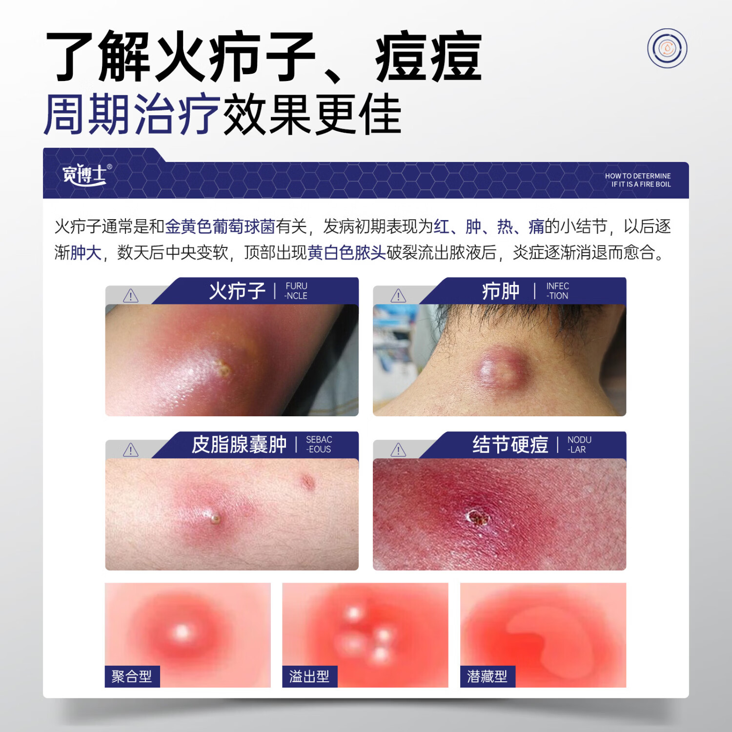 宽博士祛痘凝胶医用透明质酸钠修复软膏去火疖子改善痘痘 三盒【巩固装】