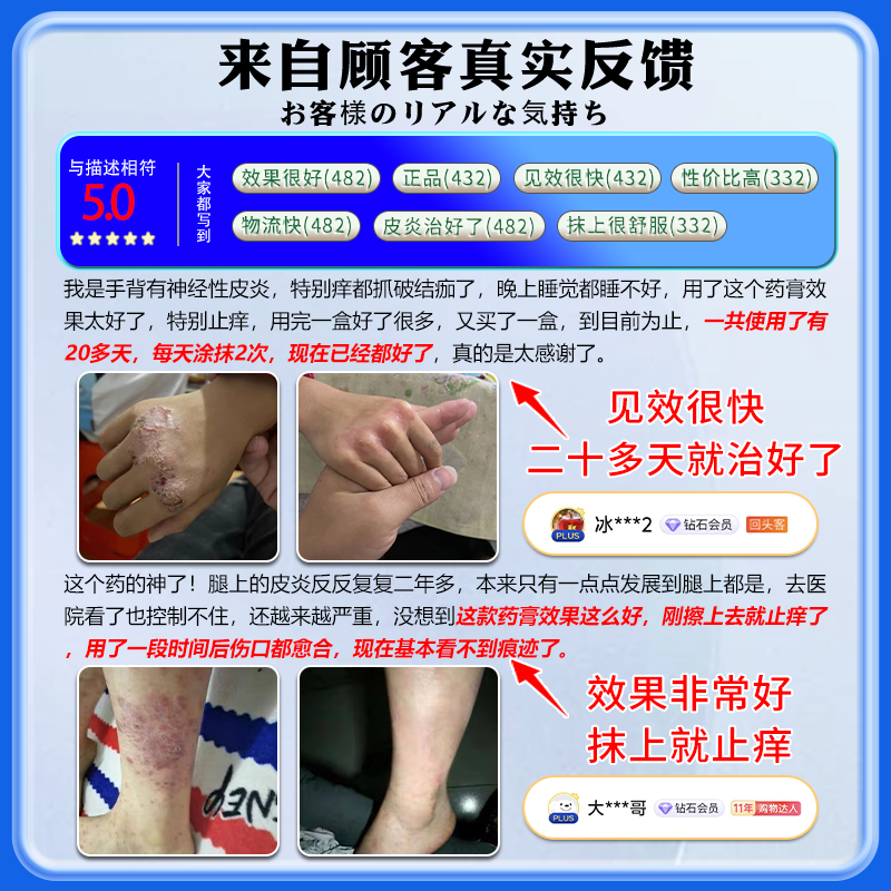 岩井昃弘神经性皮炎专用膏药顽固皮肤瘙痒皮炎湿疹真菌感染止痒日本进口 特强效一盒【日本原装进口】 眼皮癣过敏干燥无激素