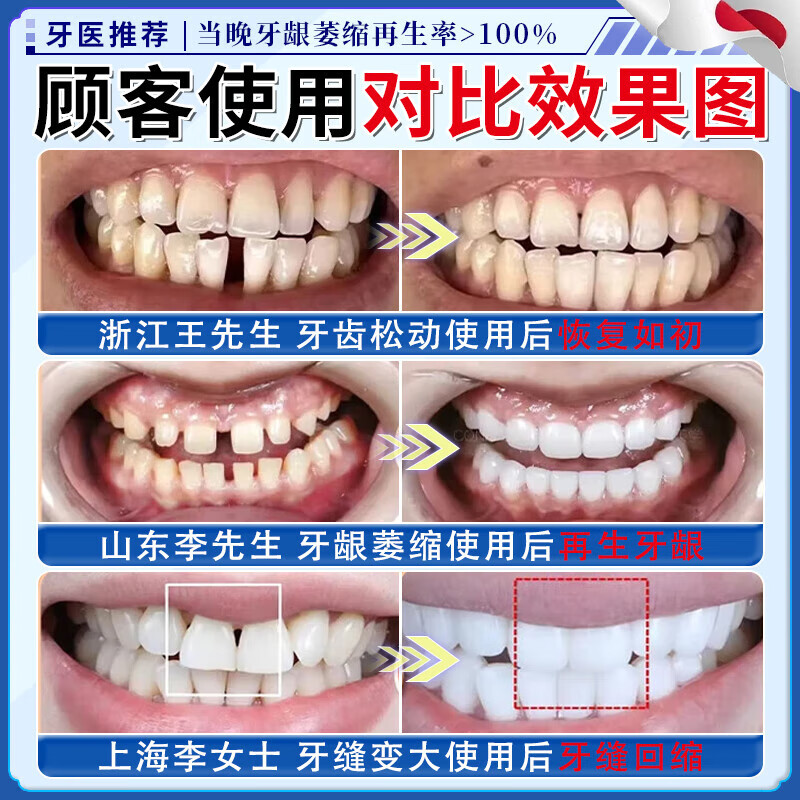岩井昃弘牙膏护龈固齿牙龈萎缩修复再生专用喷剂牙根外露牙周炎固齿凝胶 单盒装喷剂 牙膏金榜第一重度牙齿松动进口