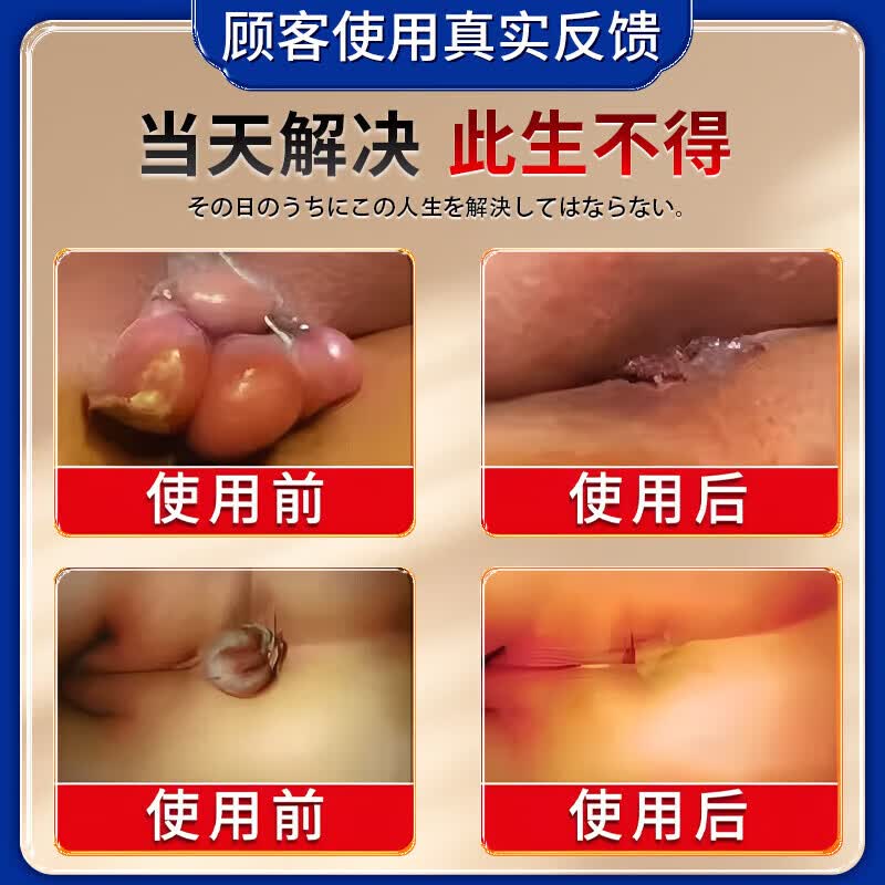 藤原石川制薬痔疮膏凝胶专用去肉球断根断痔膏去内外混合痔疮效果药痔根断正品 特强效3盒膏+3盒消痔凝胶【800%断跟】黄济川正品 痔疮医用凝胶专消脱肉球根i治断快速止血止痛消肿