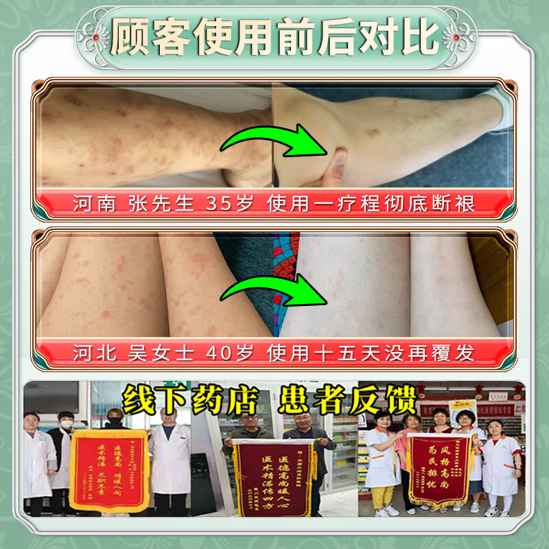 北京协和医学院止痒抑菌皮肤瘙痒身体痒止痒100%湿炎真菌感染皮疹过敏不反复 一盒装【老人皮肤痒】