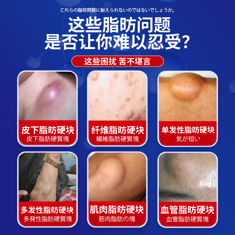云南本草脂肪康脂肪瘤专用膏药去除神器消除硬块鼓包脂肪消散膏皮下囊肿 3盒贴+3盒膏【一次性冶裉】 陈九玄脂肪瘤膏皮下多发性鼓包