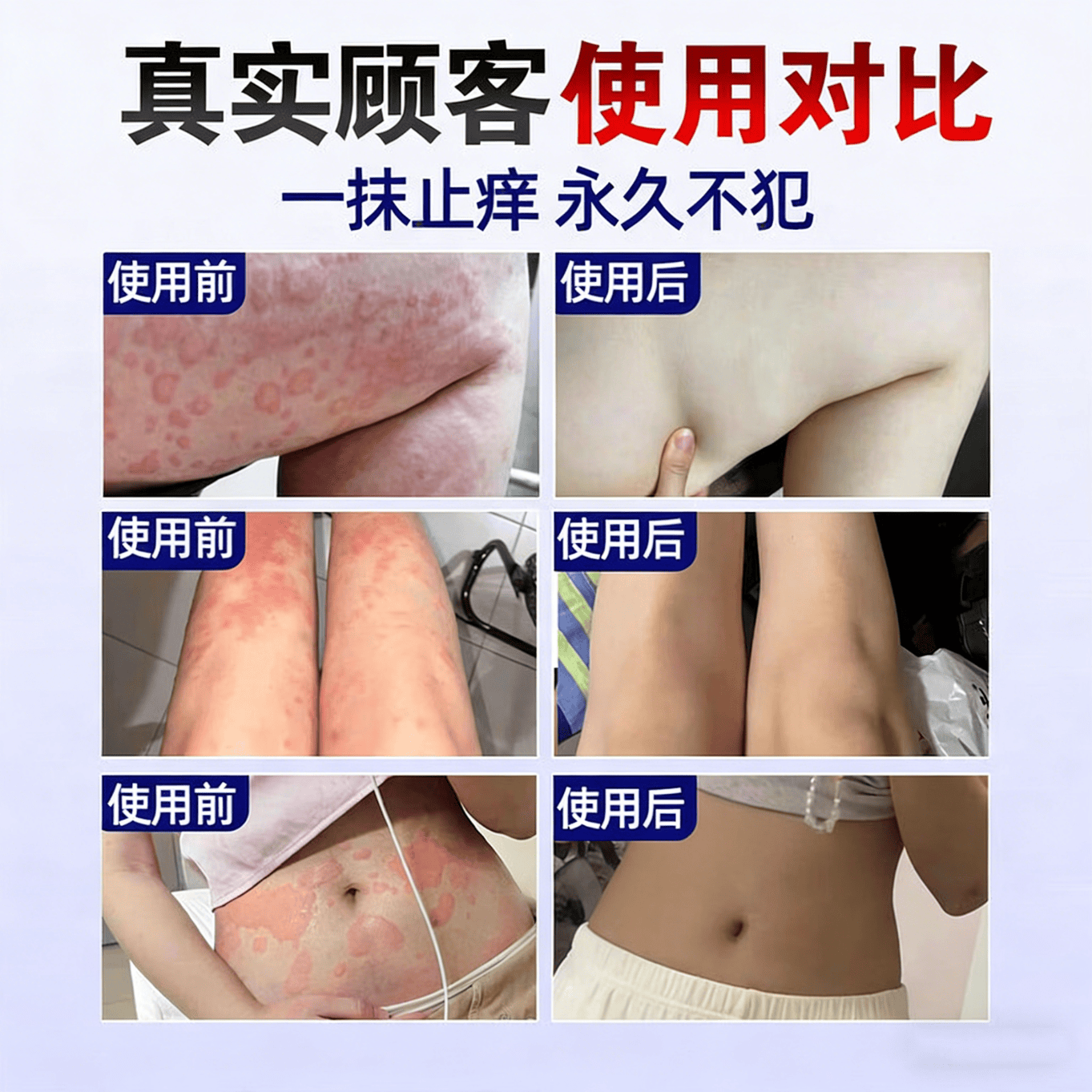 岩井昃弘荨麻疹药过敏止痒断i根增强免疫力荨麻疹专用膏药急慢性 【1盒】100%包消除 过敏止痒斷根皮肤瘙痒增强免疫膏药