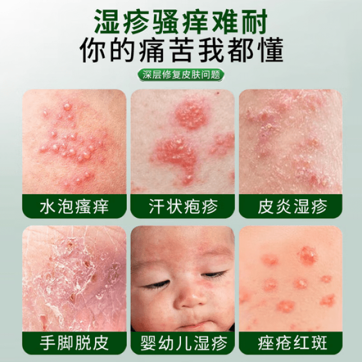 sosk康德西医用皮肤护理软膏湿疹皮炎湿疹痒皮肤瘙痒 1盒【体验装】