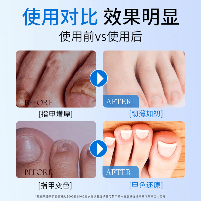 LUJAHA冰醋酸溶液30%灰指甲医用涂剂溶液药房同款灰指甲专用强效药 买三送二【周期装】 【药店同款】