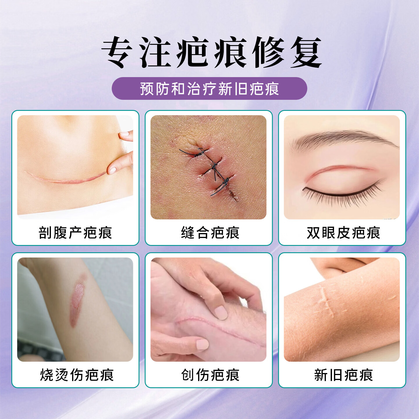 润好祛疤膏创伤疤痕剖腹产手术增生疤痕修复医用自风干型祛疤硅凝胶 医院款30g 1支体验装【初期轻微小面积疤痕推荐】