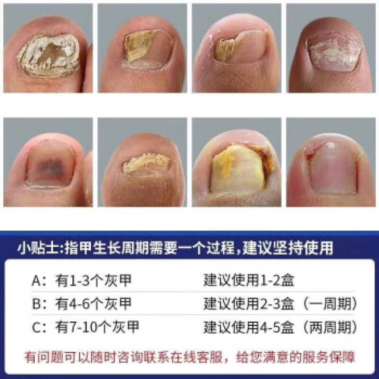 黄辅堂盐i酸阿i莫i芬i罗搽剂™擦灰指甲专用指甲真菌感染甲沟炎脱甲抑菌 1盒装+棉签