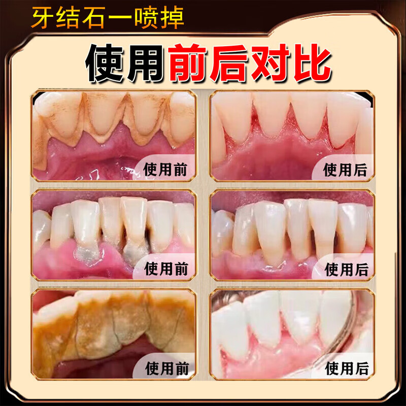 香港大药房牙结石清理神器溶解液去牙垢牙结石清除速效清理神器口臭去黄喷雾 5盒：（结石不再来）买3送2