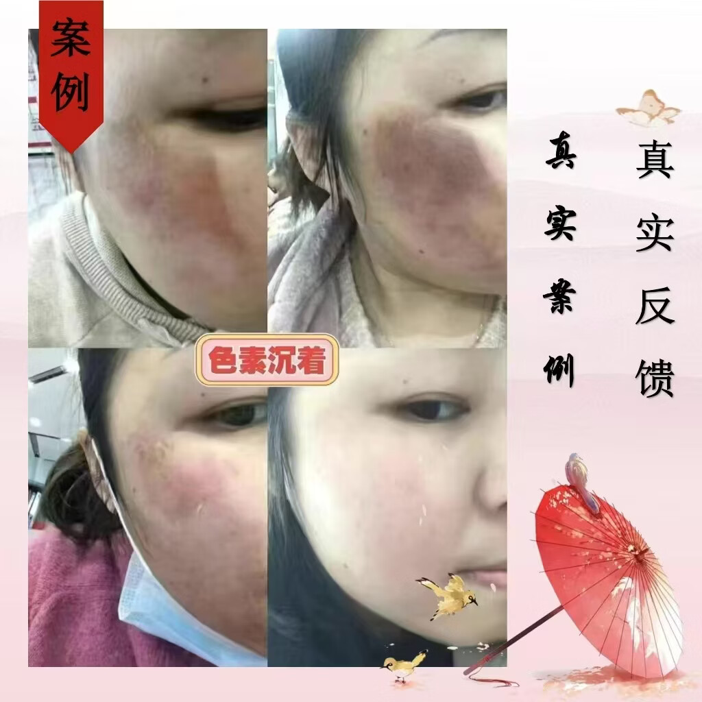 芭舒克疤痕抑菌液疤痕软化液增生疤烧伤疤烫伤疤疤痕疙瘩红色凸起疤色素 增生疤痕红色凸起烧烫伤疤痕