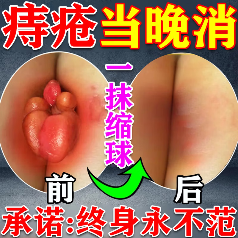 岩井昃弘痔疮凝胶100%特傚效专用膏药去i肉球内外混合痔疮去i肉球根断消痔 1支装【内外痔专用膏药】日本断痔膏