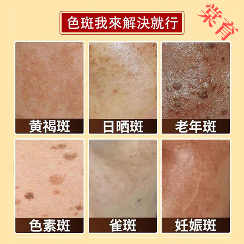 BEIYVS印度檀香木祛斑皂进口淡斑专用天然木质香手工皂洗澡洗脸精油皂 五块装 官方直售