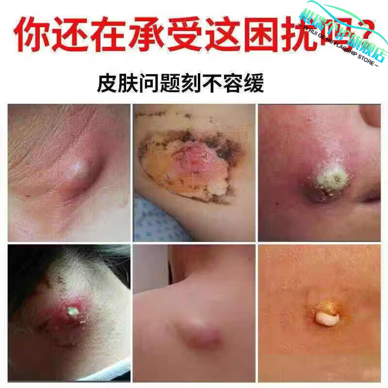 枇瑞氯霉素软膏火疖子屁股硬块脓包红疙瘩坐板疮红肿发炎皮肤瘙痒 氯霉素软膏 一支装【轻度症状】 【官方直售 京质保障】