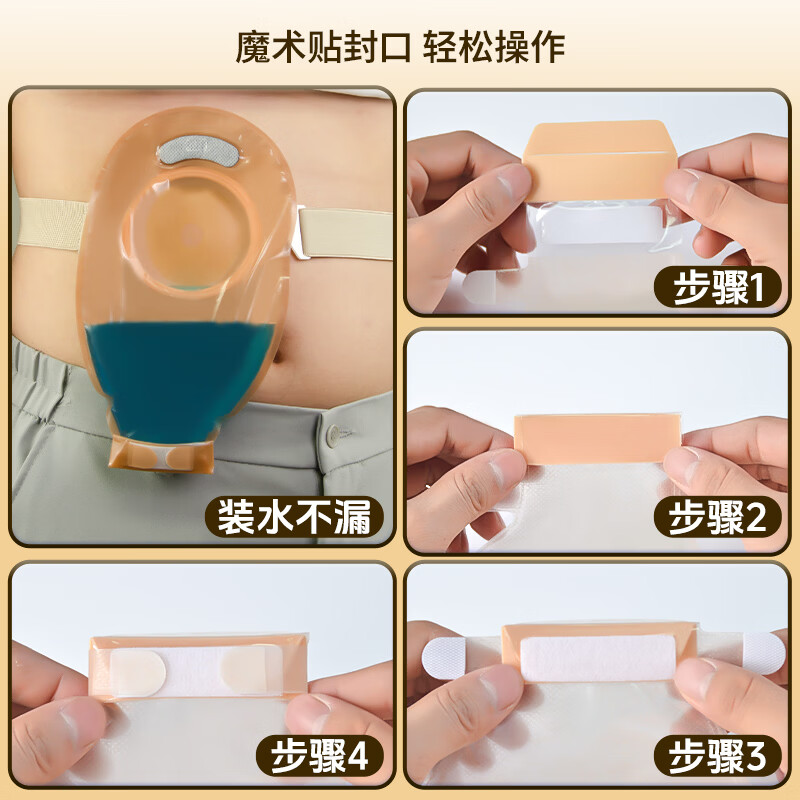 护士同学二件式造口袋60MM大剪孔凸面底盘碳片排气一次性医用两件式造瘘袋 10个袋子【囤货装】