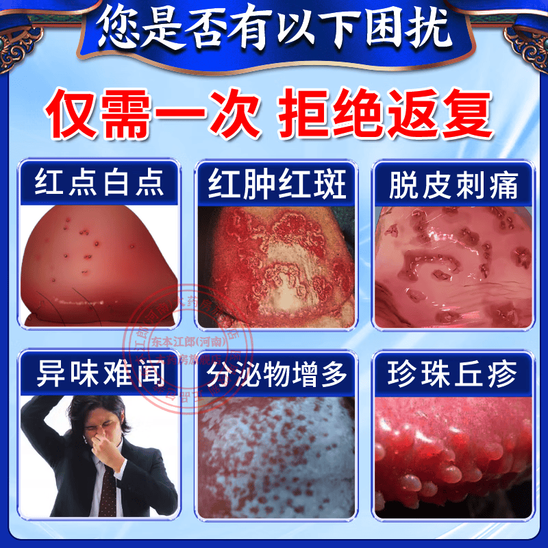 [华青]克霉唑乳膏 龟头瘙痒炎真菌感染京大东大药房龟头红肿红点瘙痒抗霉菌白垢豆腐渣私处男士皮肤专用药 10g 2盒装 【建议疗程装】