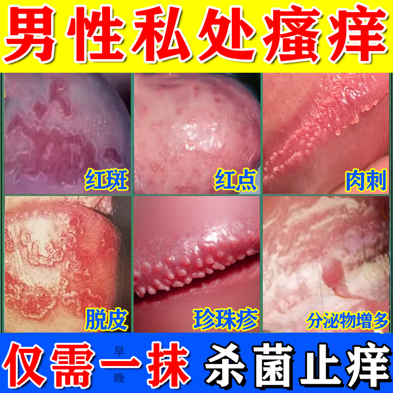 [华青]克霉唑乳膏 龟头瘙痒炎真菌感染京大东大药房龟头红肿红点瘙痒抗霉菌白垢豆腐渣私处男士皮肤专用药 10g 2盒装 【建议疗程装】 京东折扣/优惠券