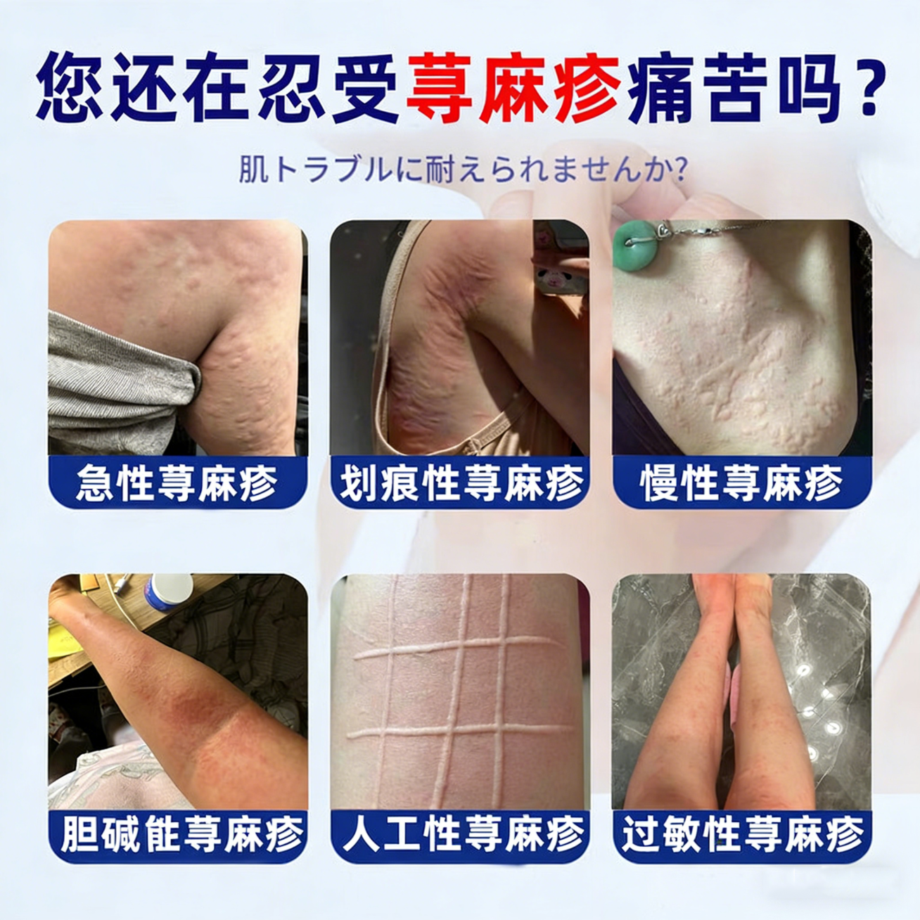岩井昃弘荨麻疹药过敏止痒断i根增强免疫力荨麻疹专用膏药急慢性 【1盒】100%包消除 过敏止痒斷根皮肤瘙痒增强免疫膏药