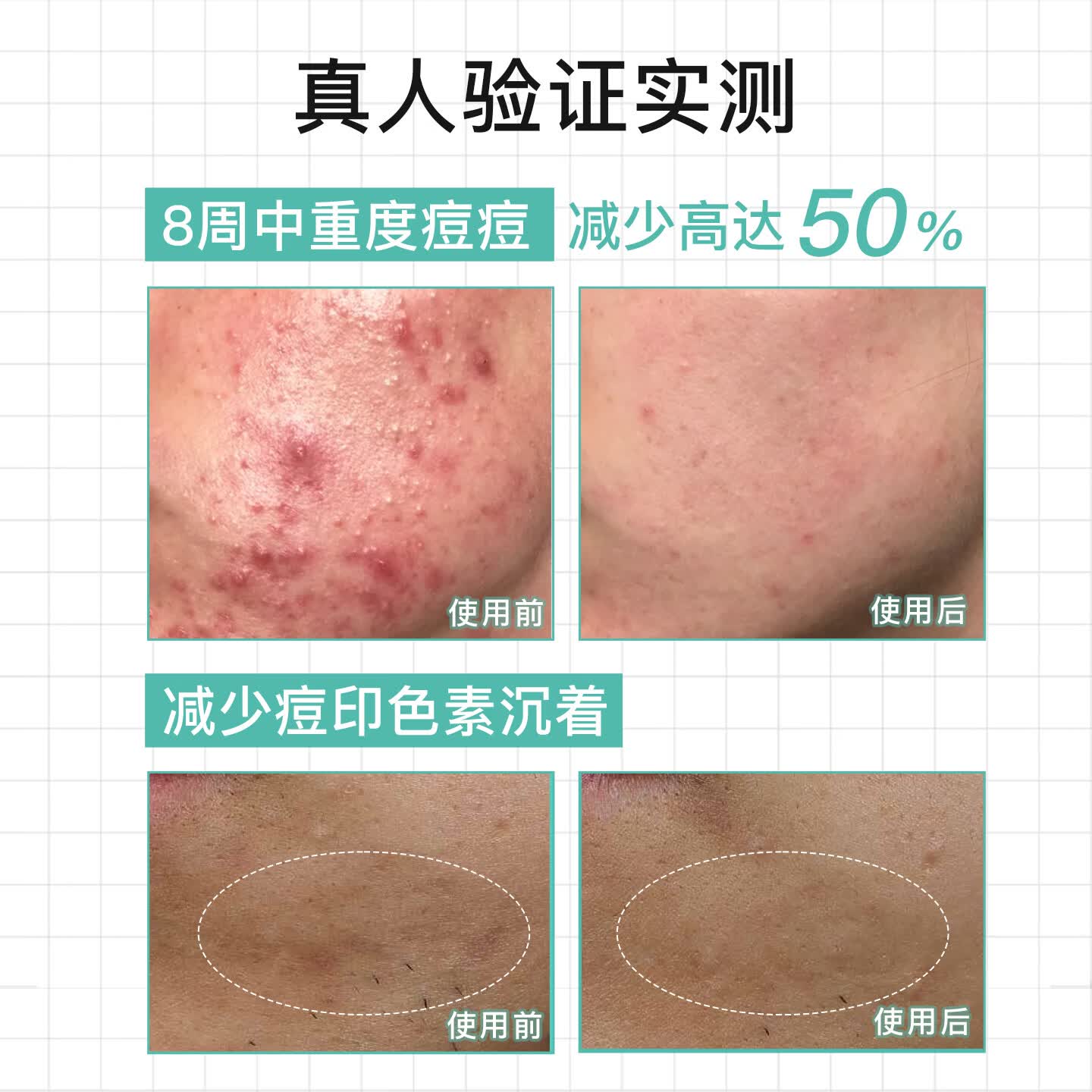 NOVEXPERT诺士博青少年祛痘精华淡化痘印 控油收毛孔 清爽无油光孕妇护肤品 [单支装]多效祛痘30ml