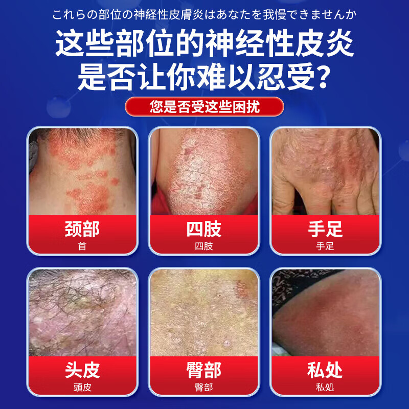 岩井昃弘神经性皮炎专用膏药顽固皮肤瘙痒皮炎湿疹真菌感染止痒日本进口 特强效一盒【日本原装进口】 眼皮癣过敏干燥无激素