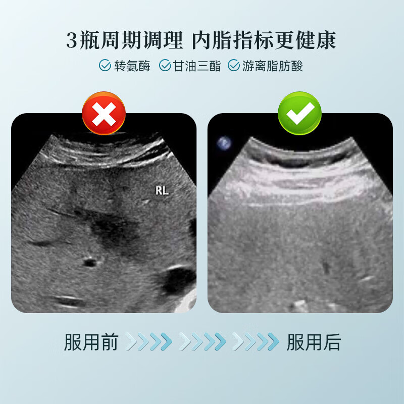 LNUPTO乐优普康乐优肝护肝片清脂护肝胶囊降胆固醇降转氨酶排毒解酒官方 6瓶装【长期调理 修复肝脏 养肝巩固】