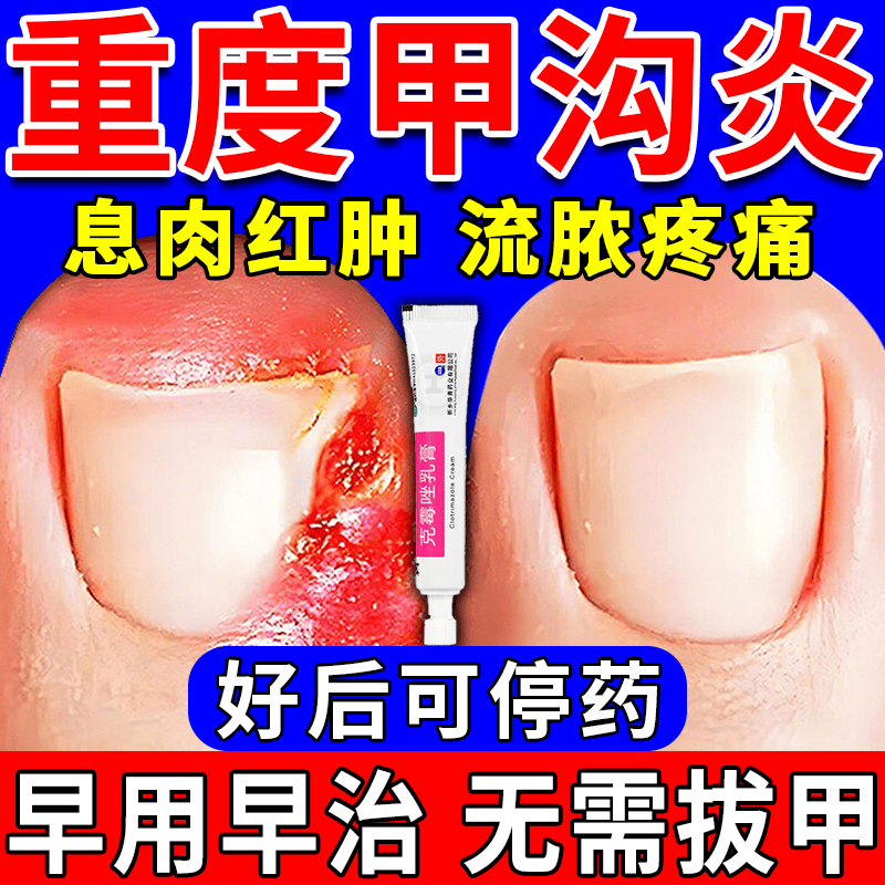[华青]克霉唑乳膏 10g 2盒装 甲沟炎专用去药根部治脚趾甲往肉里长消肿止痛去肉芽治严重息肉外用消炎药【视觉特效】