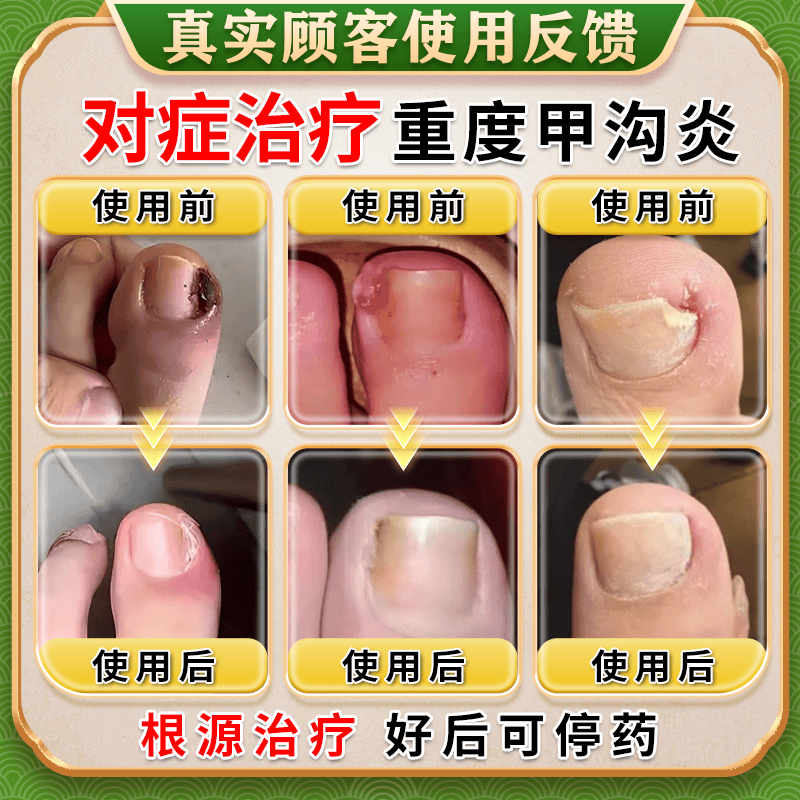 [华青]克霉唑乳膏 10g 2盒装 甲沟炎专用去药根部治脚趾甲往肉里长消肿止痛去肉芽治严重息肉外用消炎药【视觉特效】