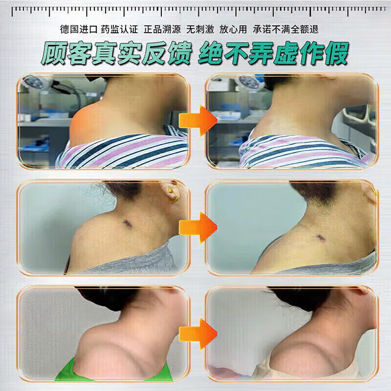 岩井昃弘富贵包消除贴颈椎疼痛治后颈鼓包专用疏通按摩矫正神器日本膏贴药 特效治【800%必冶好】 12贴*3盒 治疗富贵包日本原装进口膏贴