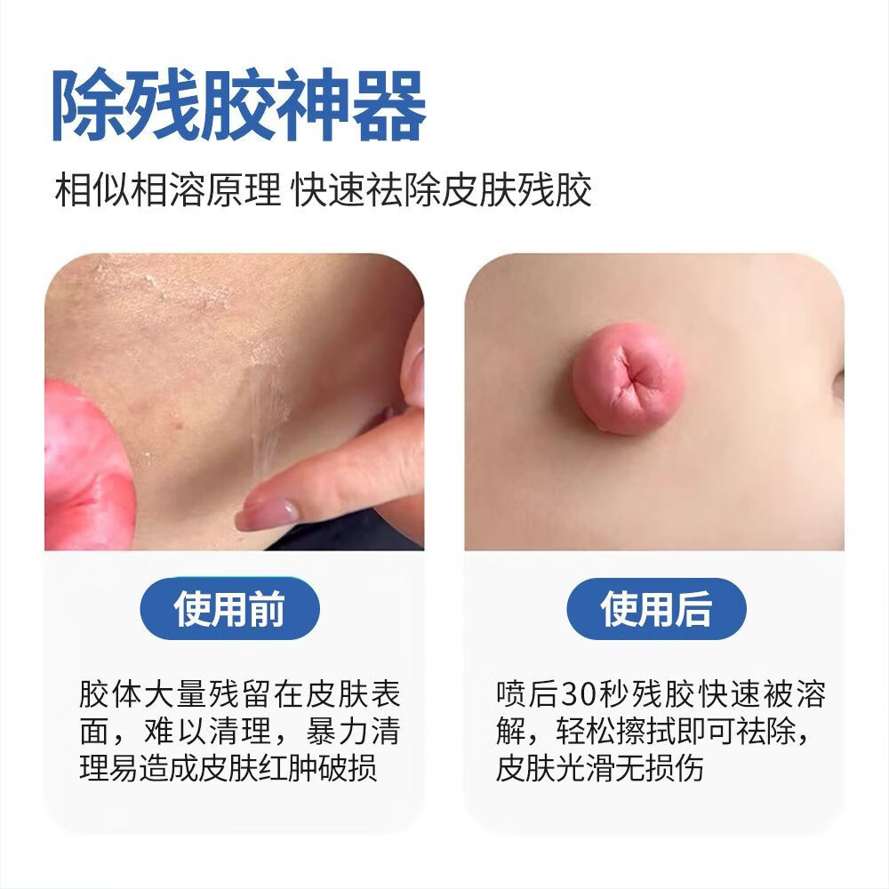 宇象多功能除胶剂超强去胶黏胶祛除粘胶剥离剂残胶去除造口袋医用正品 【买三送一/发四瓶】囤货专选*店长推荐