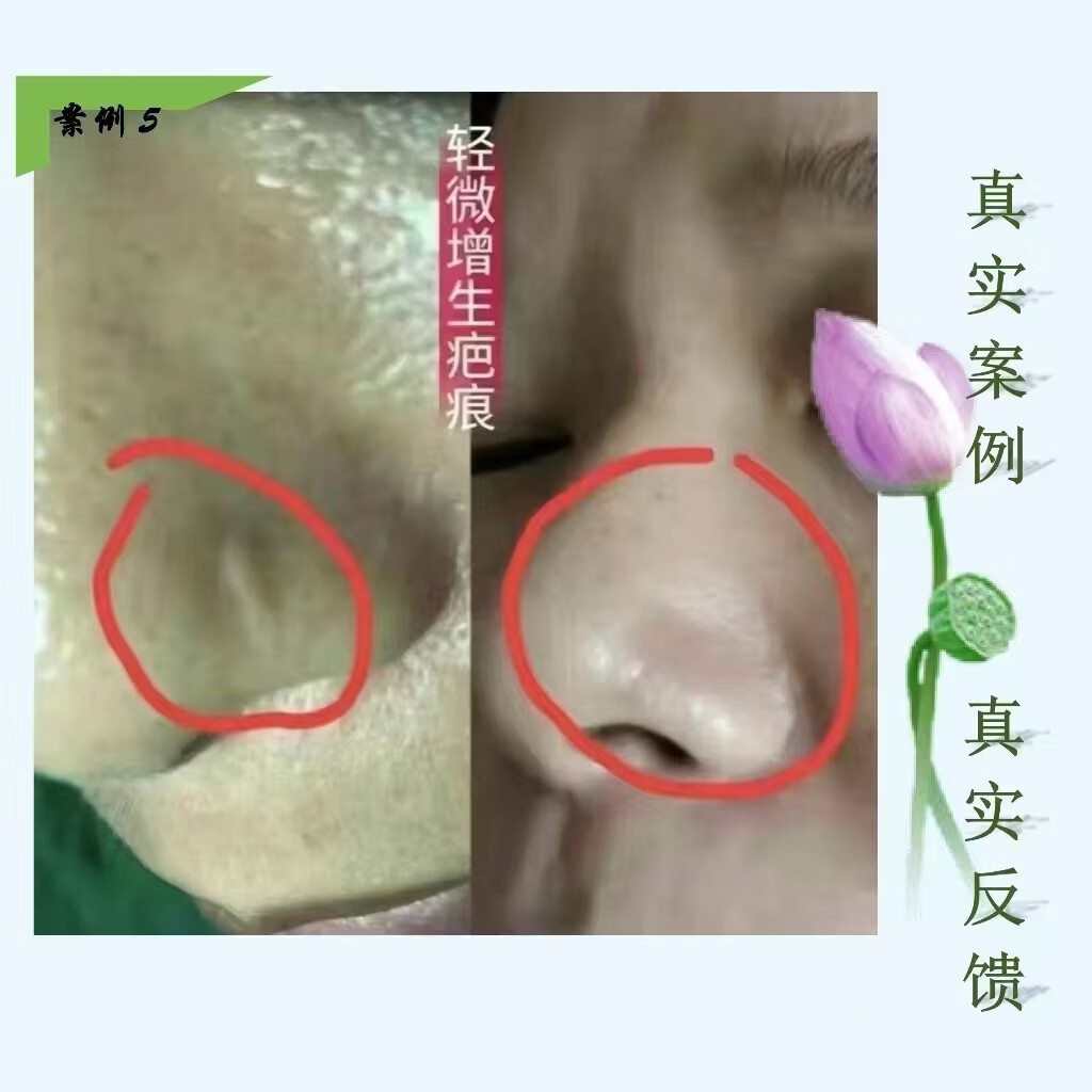 芭舒克疤痕抑菌液疤痕软化液增生疤烧伤疤烫伤疤疤痕疙瘩红色凸起疤色素 褐色