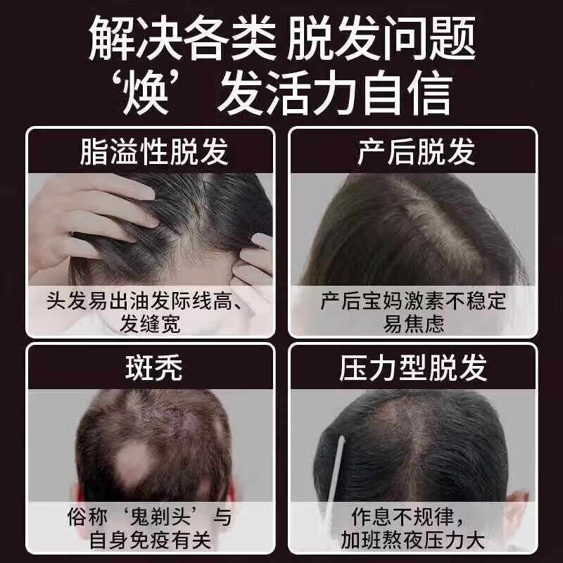 [蔓迪]米诺地尔酊 5%*30ml*2瓶 1盒装 米诺地尔5%男士治防脱发生发发际线增长液脱发斑秃秃发生发液正品大药房OTC 京东大药房