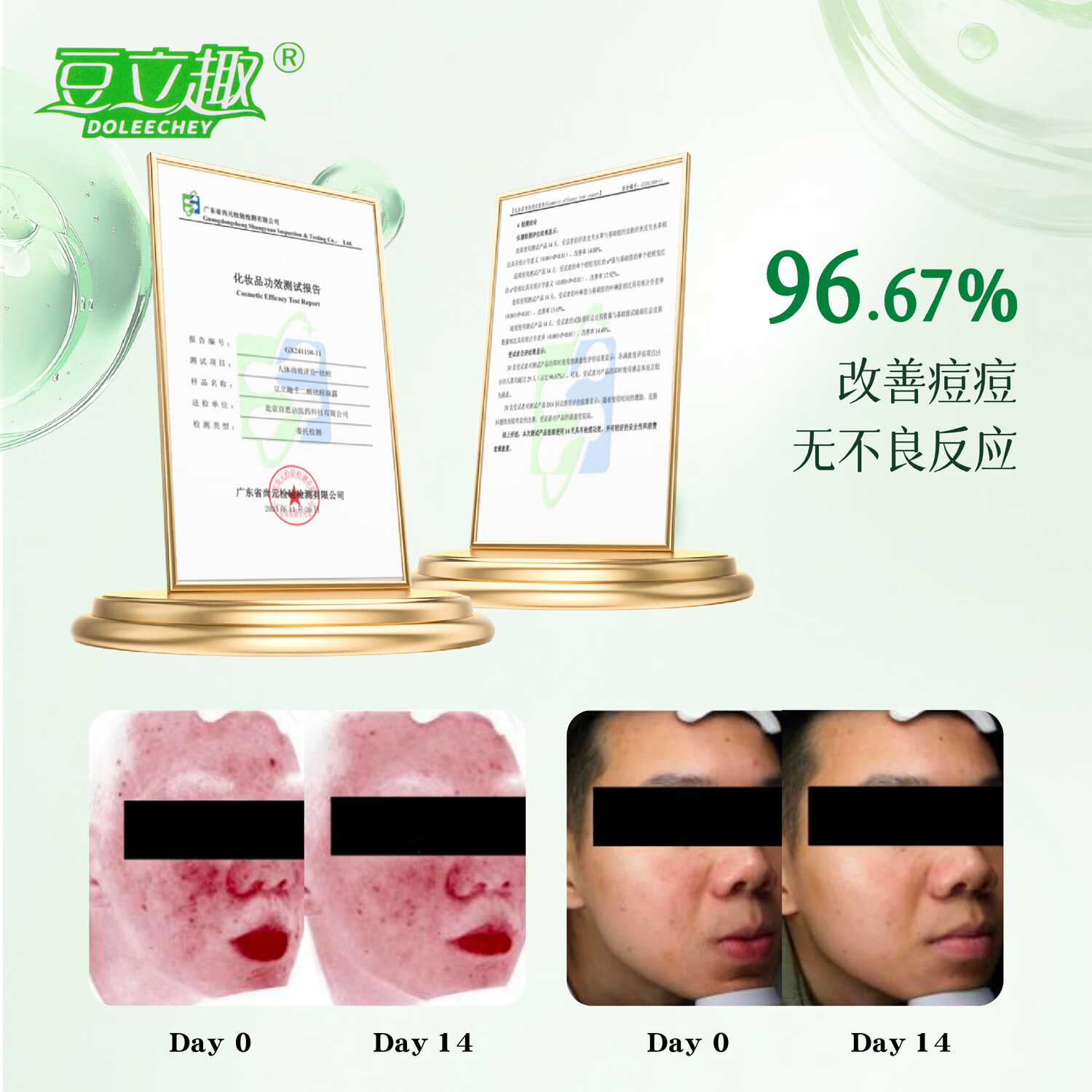 豆立趣DOLEECHEY15%壬二酸祛痘美肤凝露祛痘改善黑头及闭口呵护肌肤 15%壬二酸