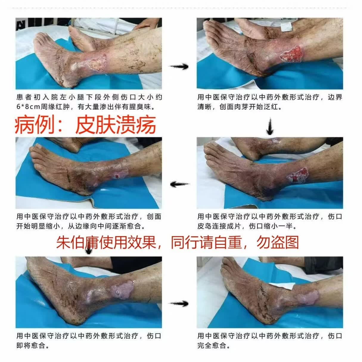 朱伯庸三黄血竭保健膏糖足膏褥疮膏卧床老人护理膏糖尿病足健字号 黑色