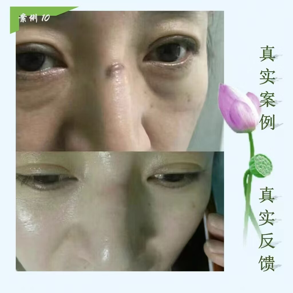 芭舒克疤痕抑菌液疤痕软化液增生疤烧伤疤烫伤疤疤痕疙瘩红色凸起疤色素 褐色