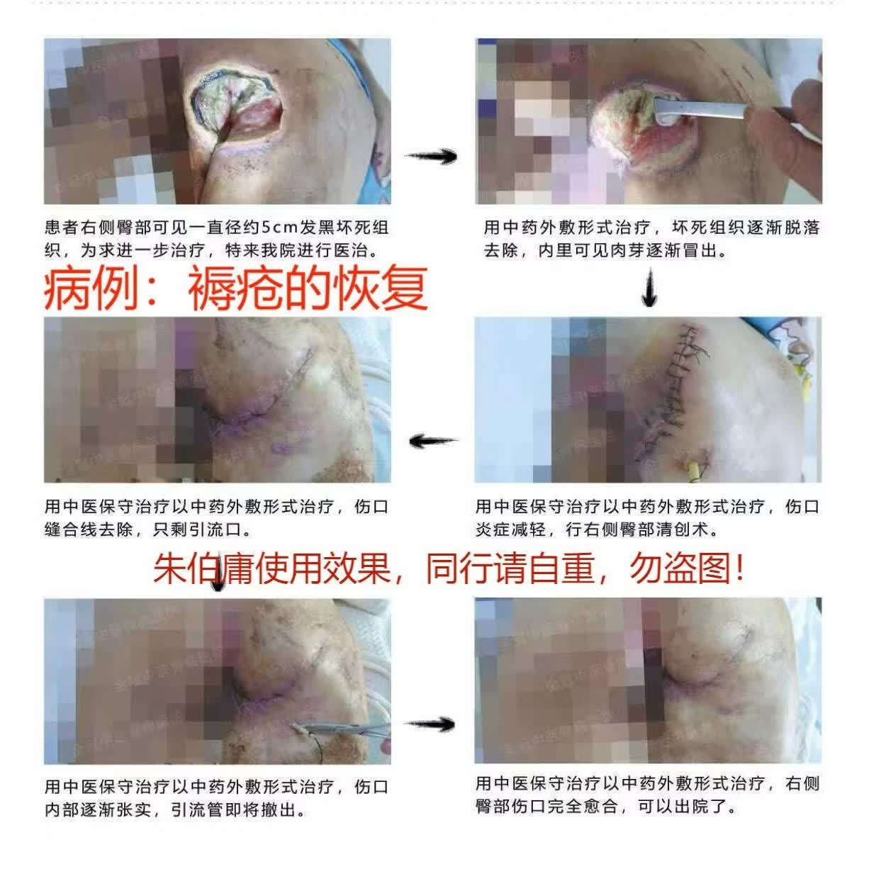 朱伯庸三黄血竭保健膏糖足膏褥疮膏卧床老人护理膏糖尿病足健字号 黑色