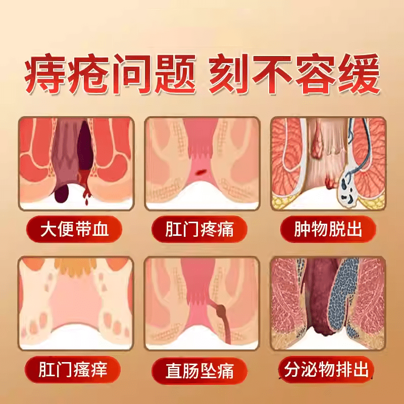熏姿颜豫百年痔疮膏消女男性枯痔散痔正品肉球断i痔中药偏方缓解男女内 5盒装【加强巩固】 官方授权旗舰店
