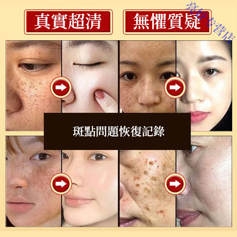 BEIYVS印度檀香木祛斑皂进口祛黄褐斑美白老年斑强力去除一夜消不留疤 五块装【滋润亮白】买三送二 官方直售 京质保障